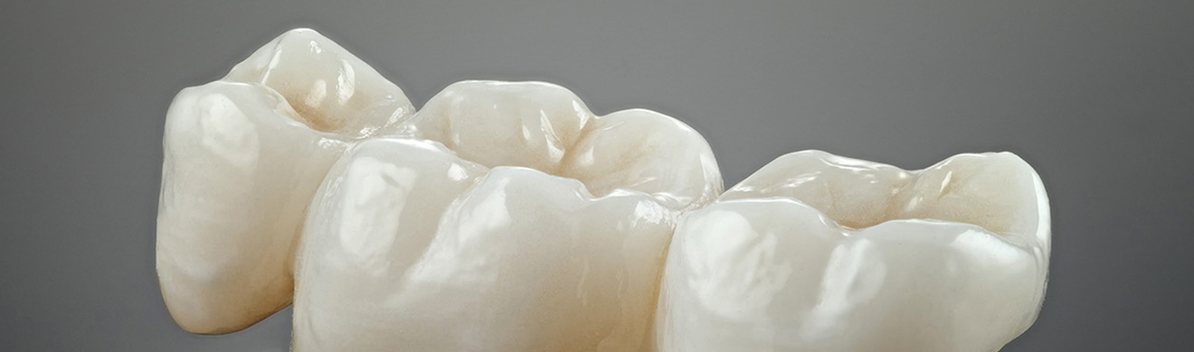 Nahaufnahme metallfreier Keramikkronen – ästhetischer, natürlicher Zahnersatz im Kreis Ahrweiler für gesunde Zähne.